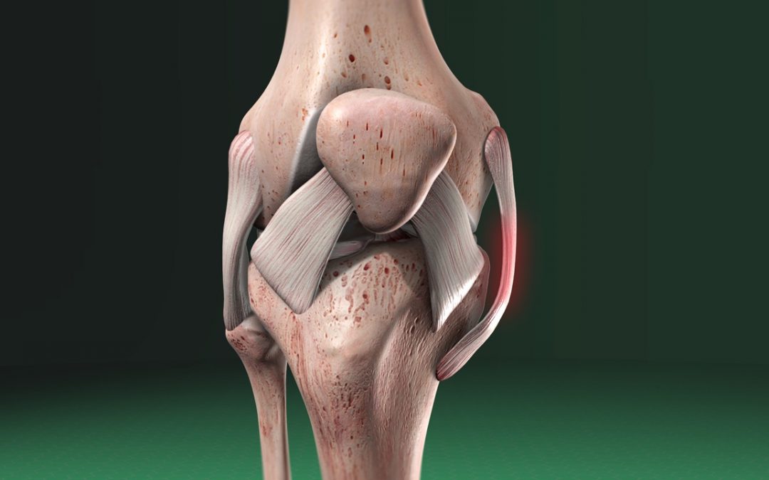 Medial Collateral Ligament (MCL) Injury of the Knee